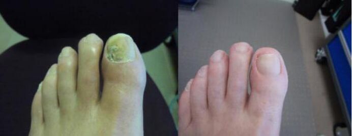Φωτογραφίες ποδιών πριν και μετά τη χρήση της κρέμας Zenidol