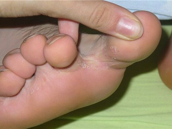 Συμπτώματα μύκητα στα νύχια των ποδιών