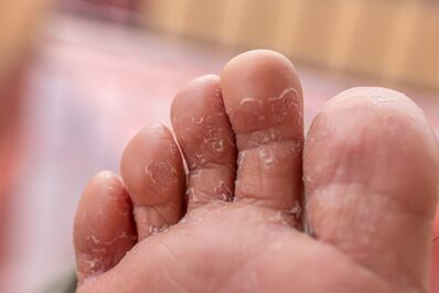 Συμπτώματα μυκητιασικών λοιμώξεων των ποδιών