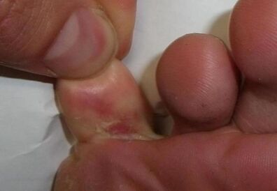 μια ρωγμή στο δάκτυλο είναι αποτέλεσμα μυκητιασικής λοίμωξης